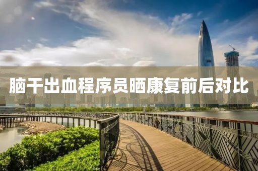 脑干出血程序员晒康复前后对比